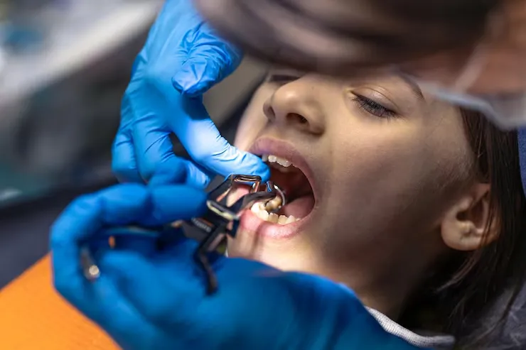 Tooth Extraction in Ravet, Punawale, Nigadi, Kiwale, Chinchwad, Dehuroad